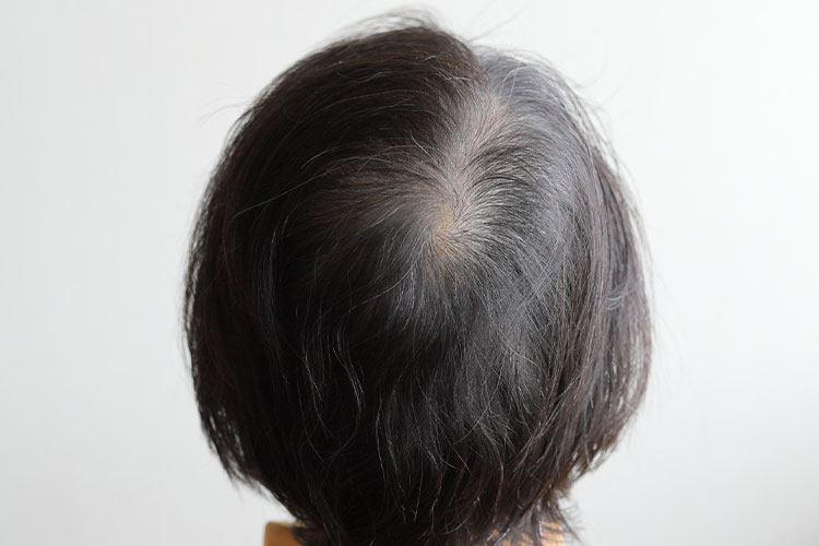 女性の薄毛
