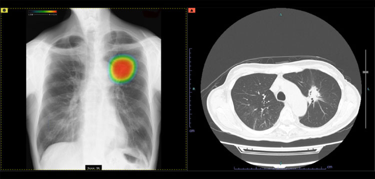胸部X線診断へのAI活用